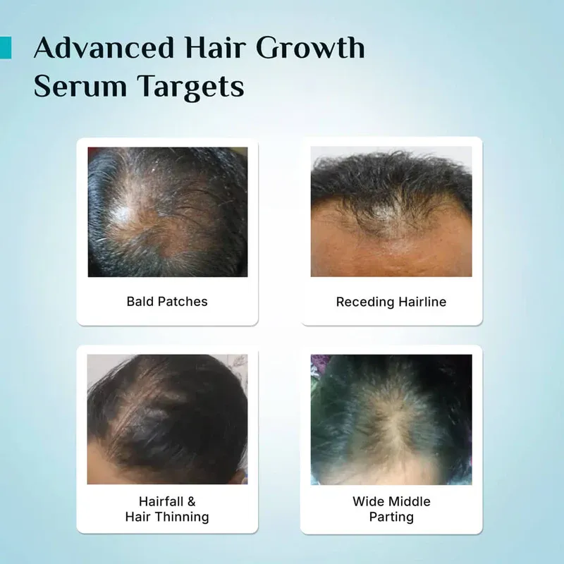 3% Redensyl, 4% Anagain & 5% Capilia Stem Cell Complex Advanced Hair Growth Serum(Buy One, Get One Free)