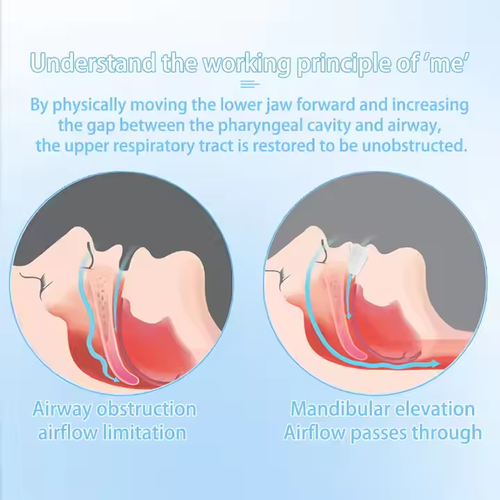 Multifunctional anti-snoring silicone braces Worry-free correction of sleep oral hygiene products Multi-purpose oral braces