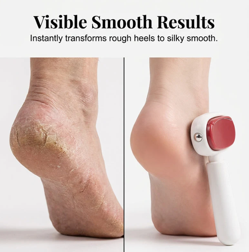 ✨DLJ-Cepin✨Double-Sided Foot Scraper for Callus Removal