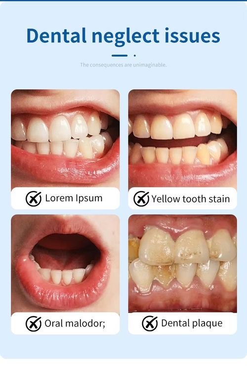 Teeth Whitening
